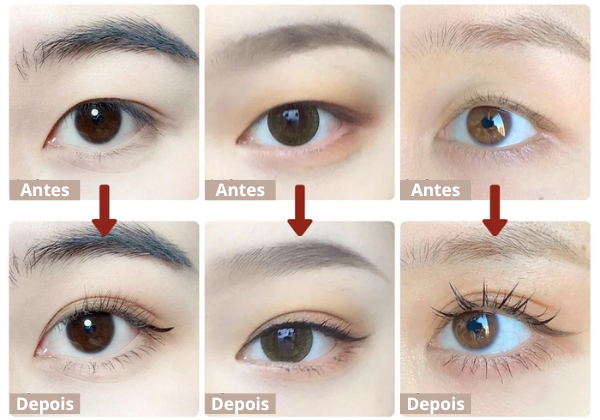 Lifting Pálpebra - Rejuvenesça seu olhar em segundos